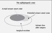 Principles of the Epileptogenic Region (ER) Lüders HO, Epileptic Disord 2006;8 (Suppl.