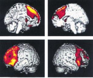 FRONTOTEMPORAL DEMENTIA 225 FIG. 1. Display of cerebral areas with significant hypometabolism (p < 0.001 uncorrected) projected on a MRI template of the normal brain.