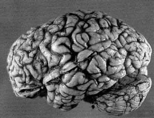 226 A. MICHOTTE ET AL. FIG. 3. Left lateral view of the brain showing moderate atrophy of the frontal lobe. FIG. 4.