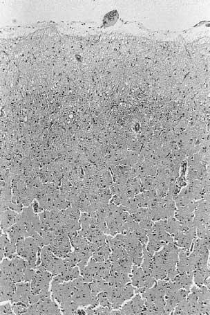 FRONTOTEMPORAL DEMENTIA 227 FIG. 5. Photomicrograph of the left frontal cortex showing the microvacuolar spongiosis in the upper layers associated with neuronal loss and gliosis.