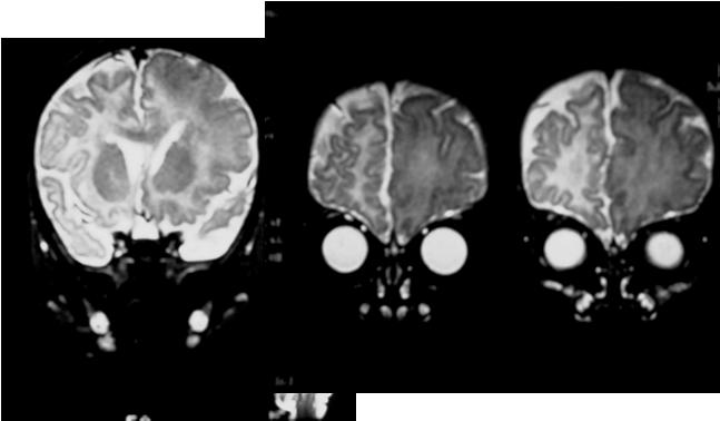 Severe cortical dysplasia and