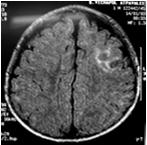 Neuro Imaging: MRI Higher Resolution & Better Tissue Differentition than
