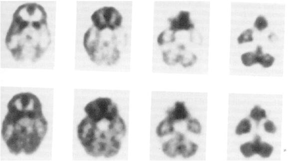 Balloon Cell FCD Neuro Imaging: FDG-PET Neuro Imaging: FDG-PET Focal