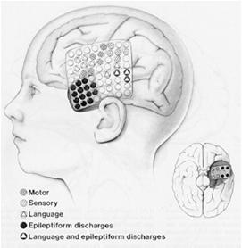 Cortical Mapping Intraoprative monitoring /Mapping/Awake Craniotomy