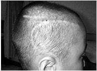 Surgically Treatble Epilepsy in Pediatrics Infant & Toddler :Cataltrophic Epilepsy only: Infantile spasms with focal lesion or foal PET hypometaboslim (HT.