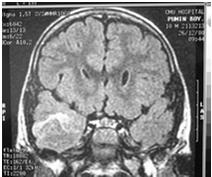 Epilepsy: lesionectomy Non-lesional Cases: May need Ictal SPECT, MRS, Invasive Monitoring Benefit of Early Surgery Better intellectual outcome, Pts can be rehabilitated with no or low seiures