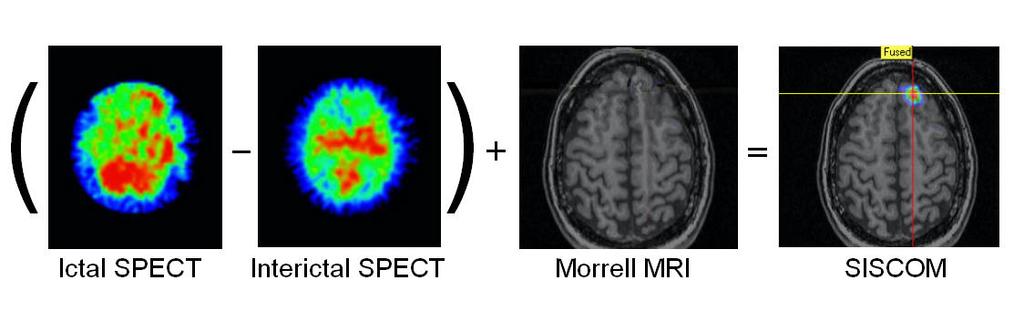 Criteria Essential to performing Ictal SPECT:. Ictal SPECT must be performed in the video-eeg monitoring unit Subtraction Ictal SPECT Co-registered to MRI (SISCOM) 998.