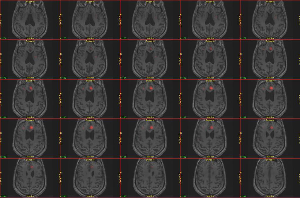 Discussion SISCOM can provide, non-invasive information for preoperative planning High concordance with intracranial recording in ETE patients with a localizing SISCOM without structural lesions on