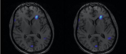 9%) Rush series ( months) TLE + ETE: 7/ (58%) ETE alone: 5/0 (50%) Discussion How useful is SISCOM for epilepsy arising from outside of the temporal lobe with non-lesional MRI data?