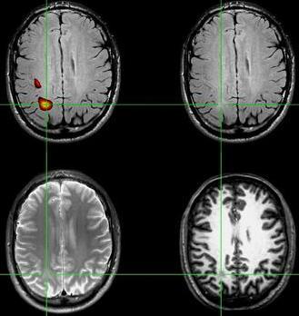MR-negative epilepsy patients and SISCOM Detection of subtle lesions (FDL) guided by SISCOM Coregistration with MPRAGE and FLAIR (3T MRI) re-evaluation of the MRI guided by
