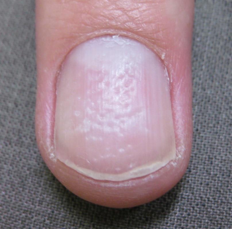 NAPSI Grading System Nail Matrix Psoriasis Features: Pitting leukonychia, red spots in the lunula, nail plate crumbling Photo depicts nail pitting in 4/4 nail quadrants Score for Matrix: 1=