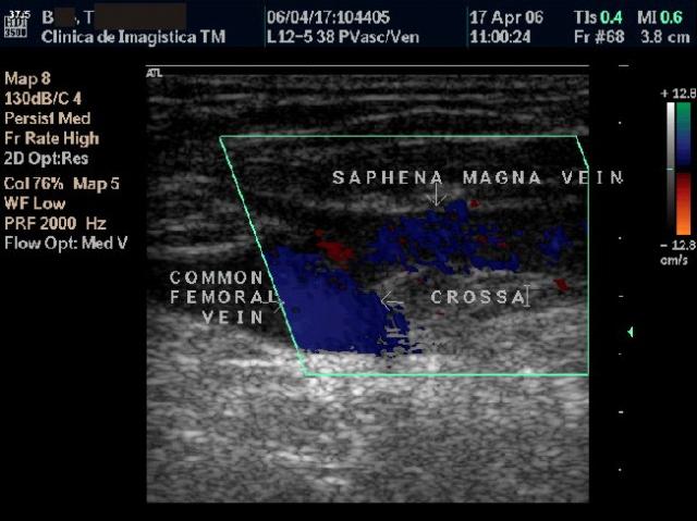 Fig. 2 a, b. Ultrasound examination and intraoperative aspect: high SVT with thrombosis 1 cm proximal to the of the GSV junction.