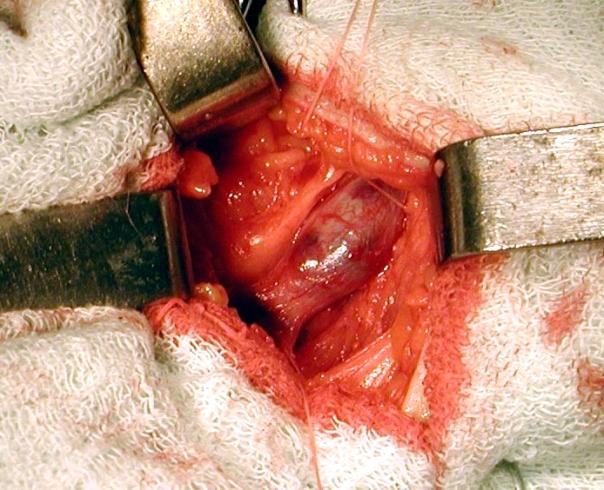 - intraoperative aspects: thrombosis of the GSV up to 1 cm from the SFJ, thrombectomy and
