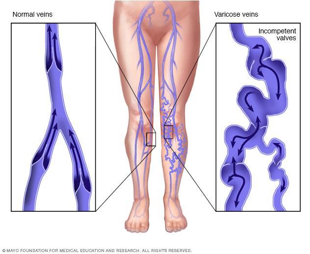 Varicose Veins Terminology Pathophysiology Chronic venous disorders Full spectrum of morphological and functional abnormalities of venous system Chronic venous disease When chronic venous disorders