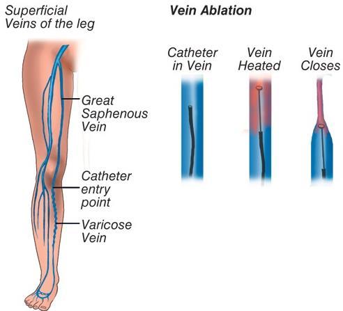 Treatment Conservative Elevation of legs, exercise, avoidance of prolonged standing Compression stockings Wound care for