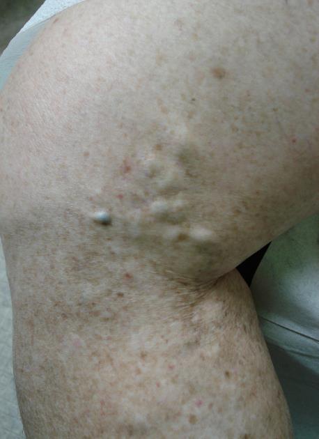 saline Thermal Radiofrequency ablation Laser ablation Cyanoacrylate glue Clinical Pearls Which varicose veins bleed?