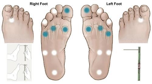 Diabetic Foot Ulcers Etiology Combination of peripheral neuropathies Motor: weakness and atrophy of foot muscles leading to deformities and altered biomechanics Sensory: loss of
