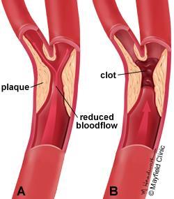 Carotid Stenosis The presence of atherosclerotic plaque in the carotid vessels.