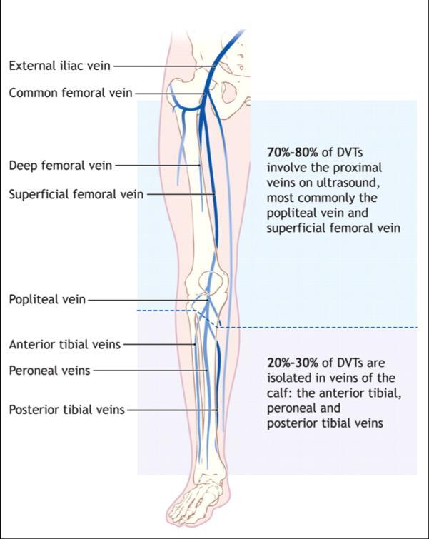 Clinical Pearl Proximal DVT o Superficial femoral vein is a deep vein and presence of a thrombus requires treatment as it is considered