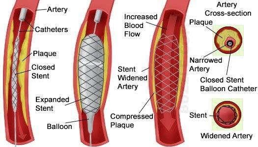stenting Key features can distinguish between vascular and neurogenic claudication o Characterization of pain Vascular consistent cramping Neurogenic