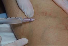 Sclerotherapy of Telangiectasias: Technique Sclerotherapy Results Injection of