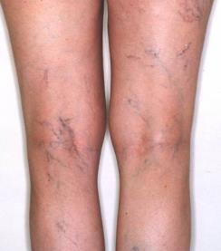 Phlebology 62 Treatment of Reticular Veins NEED PIC Frequently associated with