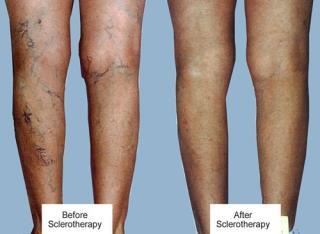 sclerotherapy effective Endovenous occlusion with radiofrequency or laser