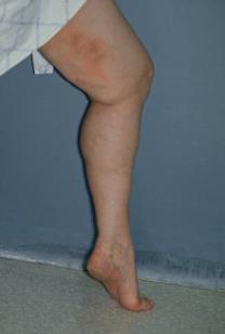 17:59-63 Copyright 2009 by American College of Phlebology 75 Venous ulceration Superficial venous disease present in >50% Initial Rx includes graduated
