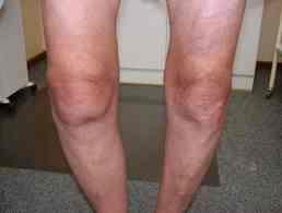 Venous Insufficiency We are not