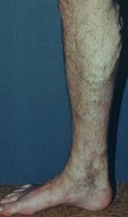 Venous Disease is a Hereditary Disorder 134 families were examined The risk of developing varicose veins was: 89% if both parents had varicose veins 47% if one parent had varicose veins 20% if