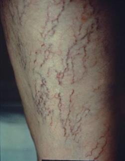 Telangiectasias Also known as spider veins due to their appearance Very common, especially in women Increase in frequency with age 85%