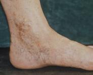 Skin changes suggestive of chronic venous insufficiency Venous