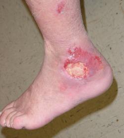 ulcers are significantly more common Venous ulcers are behind malleoli;