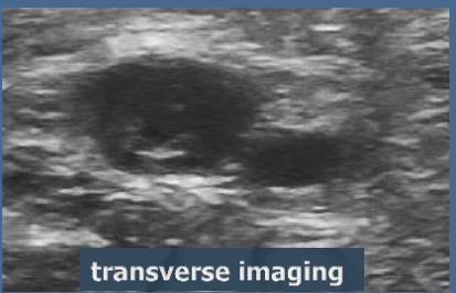 Objective diagnosis of SVT Ultrasonography: objective test of choice for confirming SVT clinical suspicion superficial veins can be easily explored same principles of DVT diagnosis: