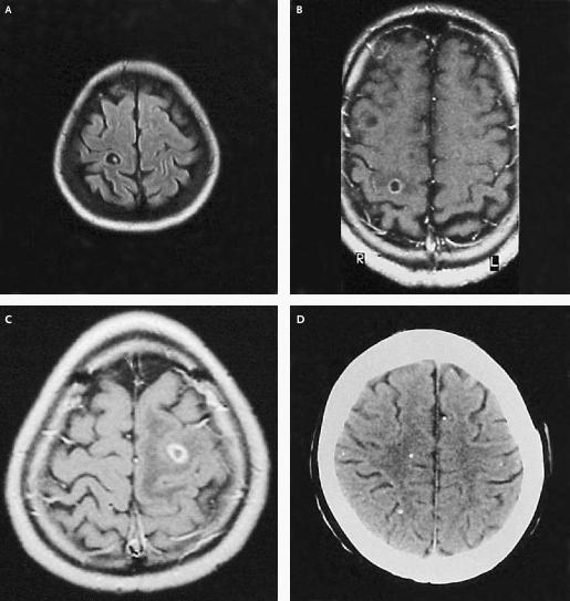 Stages of Neurocysticercosis Lesions A.