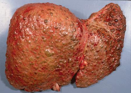 Liver Cirrhosis May be the end result of chronic cholestatic or hepatitic disease Liver synthetic function may be