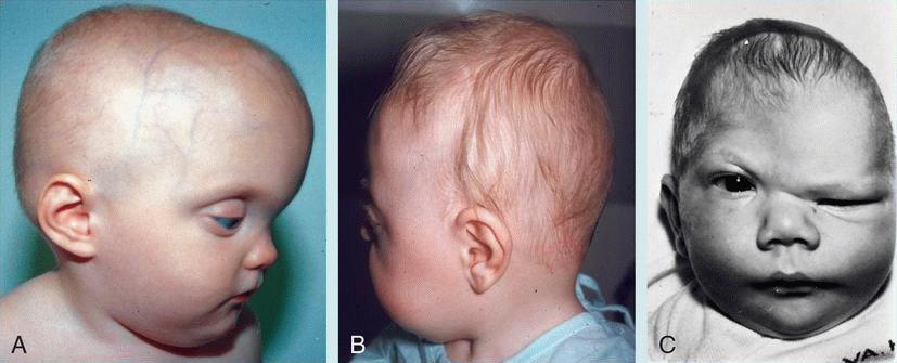 Craniosynostosis A. Scaphocephaly : early closure of the sagittal suture. Note the frontal and occipital bossing B.