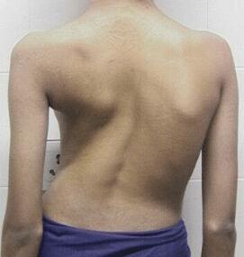 learns to walk Scoliosis (lateral curving of the spine): two successive vertebrae fuse