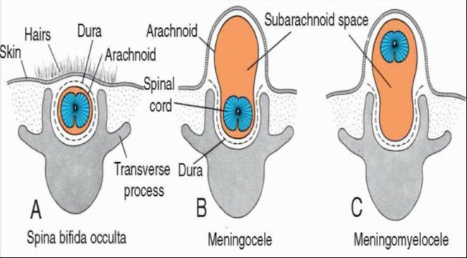 Spina bifida imperfect fusion or nonunion of the vertebral arches (a) spina bifida occulta involve the bony vertebral arches