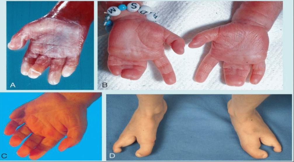 Syndactyly C.