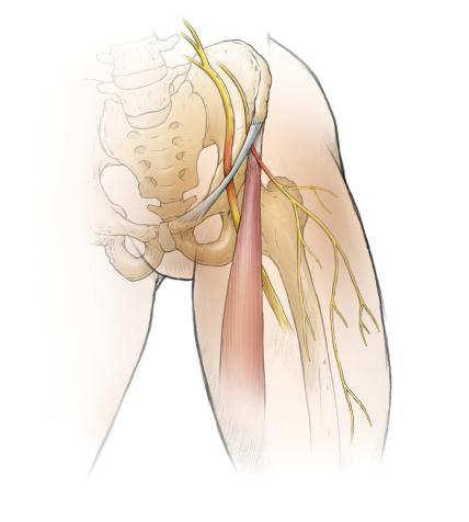 pocket (anterolateral thigh) distribution of sensory loss and burning