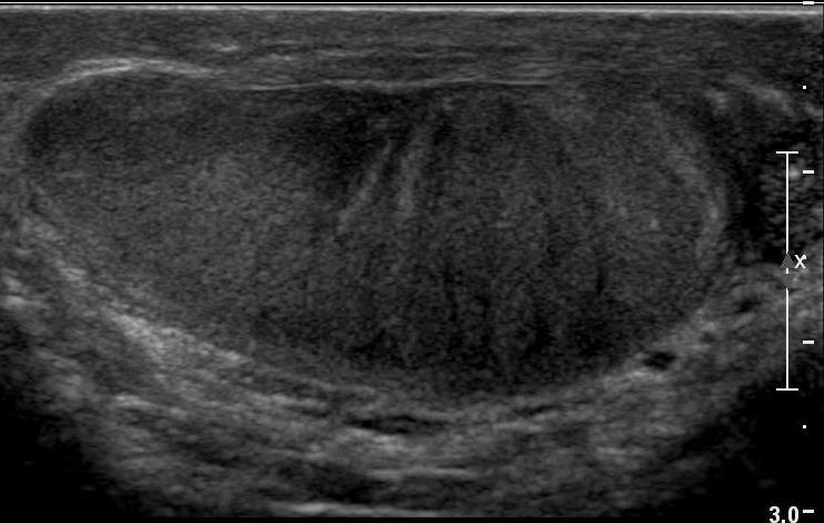 Contralateral testis showing