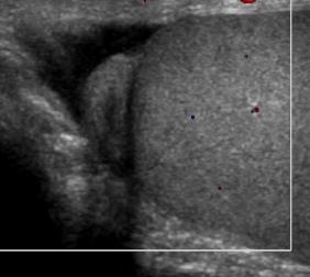 Ultrasound shows subtle increased vascularity to left testis