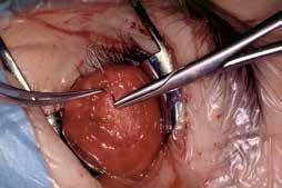 In the case of an eroding or extruding orbital implant, the conjunctiva is incised circularly