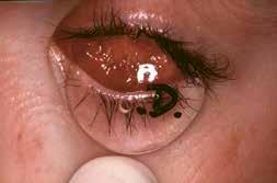 It is mandatory not to leave any conjunctival tissue in the depth of the orbital tissue to