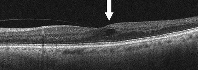 However when compred to previous colour fundus photo (Figure 10) the re ws shown to e choroidl nevus.