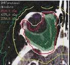 IMRT IMRT shows potential for protecting normal tissues in patients requiring external beam radiation therapy for retinoblastoma.