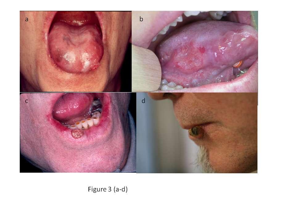 a.squamous cell carcinoma (SCC) of the tongue s point arising on an atrophic oral lichen planus. (ED) b.scc of the tongue in a 19-year-old smoker female.