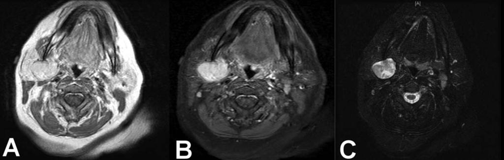 Fig. 1. Magnetic resonance image axial images. (A) T1 sequence pre-gadolinium demonstrates a well-circumscribed right parotid lesion hyperintense relative to muscle.