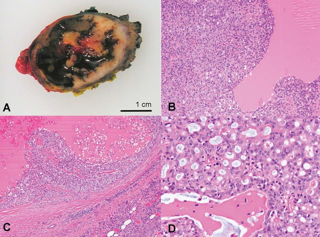 Fig. 3. Gross and histologic pathology of the tumor. (A) Gross appearance is that of a well-circumscribed partially cystic tumor.